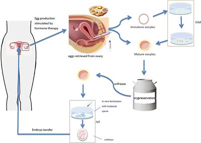 Progress in Fertility Preservation Strategies in Turner Syndrome